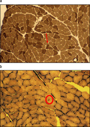Alteraciones microscópicas observadas en la sarcopenia. A) Atrofia de fibras de tipo ii (flecha). Tinción: ATPasa 9,4×400. B) Disminución del número de capilares. Tinción: Ullex Europeus×400.
