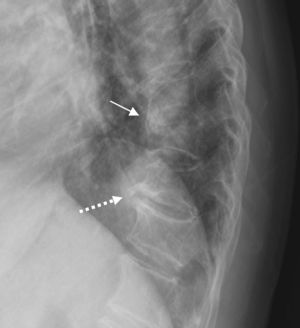 En la imagen se observa osteofitos fusionados (flecha de trazado continuo), y osteofitos que no han llegado a fusionarse (flecha con trazado discontinuo). Gracias a estos últimos, se sabe que se trata de una espondilosis deformante, y en cambio, si la radiografía realizada no hubiera incluido este último nivel del raquis, se habría podido generar confusión diagnóstica.