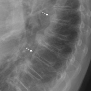 Las flechas indican las bandas radiolucentes características entre la osificación y el disco intervertebral.