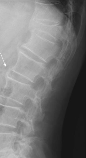 La flecha señala la típica imagen en «llama de bujía» que caracteriza la osificación de la hiperostosis, característicamente, a nivel de la columna lumbar.