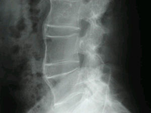 Imagen típica del sindesmofito típico; fino y vertical.