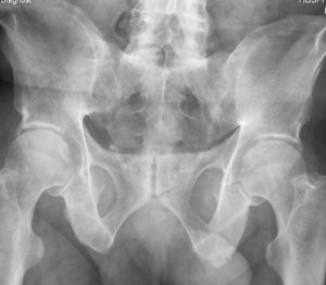 Radiografía de pelvis de paciente con espondilitis anquilosante. Anquilosis completa de la articulación sacroilíaca.