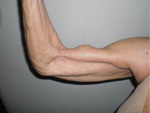 Signo de Popeye.