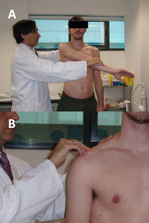 A) Maniobra de O’Brien. B) Palpación directa de la articulación acromioclavicular.