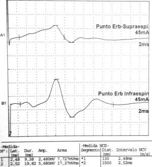 Datos correspondientes a un varón de 38 años con dificultad de abducción del MSI y escapula alata con axonotmesis de nervios de cintura escapular. Electroneurografía motora del n. supraescapular con marcada reducción en la amplitud de las respuestas obtenidas tras la estimulación. La EMG de aguja que se realizó mostró intensos signos de denervación activa (sugerente de neuropatía axonal) en la musculatura dependiente del supraescapular: supraespinoso e infraespinoso.