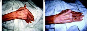 Lupus eritematoso sistémico y artropatía de Jaccoud. A) Pulgar en Z, desviación cubital de las articulaciones metacarpofalángicas de los dedos segundo a quinto de la mano y «cuello de cisne» en los dedos tercero y cuarto. B) Corrección voluntaria de las deformidades en la misma paciente.
