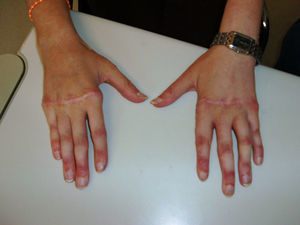 Lupus eritematoso sistémico y artropatía de Jaccoud: corrección quirúrgica.