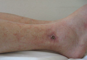 Lesiones residuales cicatriciales, con morfología estrellada, atrofia central e hiperpigmentación periférica, en la cara dorsal de ambos pies.