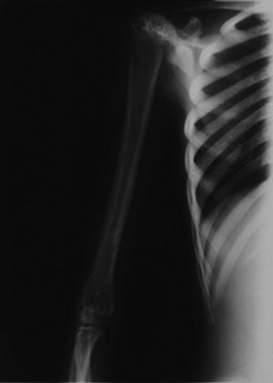 Radiografía anteroposterior del húmero derecho en la que apreciamos una hiperostosis en la diáfisis y metáfisis de este, respetando las epífisis. También podemos observar una disminución del canal medular de dicho hueso.