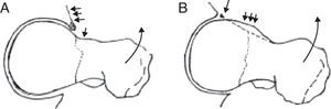 En el tipo pincer se produce un efecto palanca que lesiona el acetábulo (A). En el tipo pincer la región más protruyente lesiona el labrum (B).