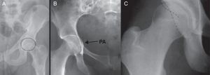 AFA tipo pincer: coxa profunda (A), protrusión acetabular (B) y signo del «8» o del lazo (C). PA: protrusión acetabular.