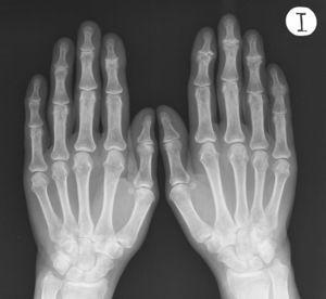Imagen de anquilosis en la quinta interfalángica distal izquierda. En la radiografía conviven alteraciones articulares en diferentes estadios.