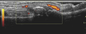 Ecografía que muestra erosiones y sinovitis con señal power doppler, en una paciente con artrosis erosiva de las manos.