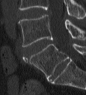 Imagen sagital de TC columna lumbosacra. Osículo de morfología triangular y margen bien definido de hueso cortical, separado del resto del cuerpo vertebral de L5 por un defecto óseo de tejidos blandos.
