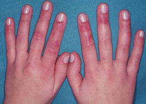 Lesiones típicas de perniosis idiopática: pápulas y nódulos violáceos en el dorso y en la cara lateral de los dedos de las manos en un paciente joven que por otra parte no tiene otra enfermedad acompañante.