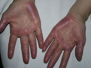 Lesiones cutáneas específicas de lupus eritematoso en las palmas que simulan una perniosis. A diferencia de esta, las lesiones en este caso son persistentes y no siguen un ritmo estacional.