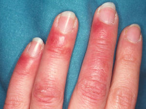 Paciente con lupus eritematoso cutáneo subagudo, con anticuerpos anti-Ro en sangre periférica, que durante los meses de invierno desarrolla lesiones eritematosas en los dedos de las manos tipo perniosis (perniosis lúpica).