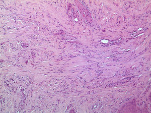 Proliferación de fascículos colágenos a nivel de dermis con patrón irregular.