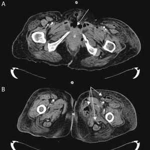 TC abdominopélvica (A) y de las extremidades inferiores (B) de una paciente de 60 años, diabética, con carcinoma endometrial metastásico, con extensa fascitis necrotizante perineal (flecha, imagen A), retroperitoneal, pared abdominal anterior y extremidades inferiores (flechas, imagen B). El cultivo de un absceso del muslo izquierdo fue positivo para E. coli multisensible.