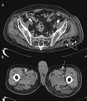 TC abdominal de un varón de 86 años, diabético y con antecedentes de cardiopatía isquémica y enfermedad cerebrovascular, con fascitis necrotizante por Clostridium septicum de localización retroperitoneal con extensión glútea (flechas, imagen A) y cuadricipital izquierda, con trombosis séptica arterial femoral izquierda (flecha, imagen B).