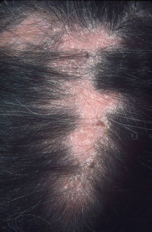 Placa de alopecia cicatricial en cuero cabelludo.