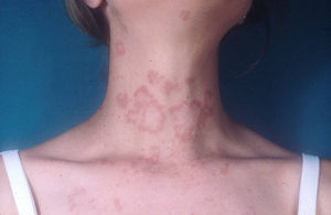 Lesiones anulares policíclicas, con borde eritematoso, en cuello y escote.