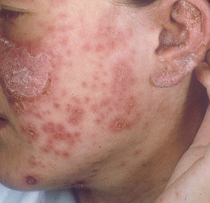 Paciente con lupus eritematoso cutáneo agudo, con lesiones hiperqueratósicas.