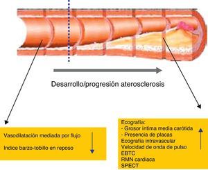 Técnicas de imagen para la valoración de la enfermedad aterosclerótica en el lupus eritematoso sistémico.