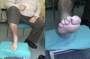 Magnitud del problema de los pies. El paciente tiene 56 años de edad, sin autosuficiencia visual ni motriz para observarse la planta del pie. Tiene polineuropatía con una disminución de la sensibilidad térmica y algésica. Se puede observar la callosidad producida por alteración de los puntos de apoyo, uñas hipertróficas y una piel fina con ausencia de vello, lo que demuestra una circulación insuficiente. Además, se corta él mismo las uñas del pie con un alicate. Vive solo, utiliza un calzado inadecuado «más barato» y no acude al podólogo por falta de suficiencia económica. Se cierra el círculo de los factores de riesgo para sufrir una lesión en los pies. (Fotografía del Dr. Calle Pascual.)