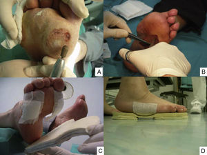 Puntos clave del tratamiento de las lesiones del pie: limpieza y curetaje de las callosidades y lesiones por presión (A), desbridar los bordes y el fondo de las úlceras hasta dejar los límites limpios y sin tejidos muertos (B), y disminuir la presión con colocación de fieltros de descarga (C) y plantillas (D). (Fotografía del Dr. Calle Pascual.)
