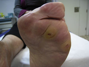 Antepié triangular.
