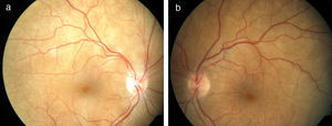 Retinografía en paciente con síndrome de Vogt-Koyanagi-Harada precoz (a: ojo derecho, b: ojo izquierdo). Se observan abundantes pliegues maculares que son compatibles con desprendimiento de retina exudativo en ambos ojos. La papila es de aspecto normal.