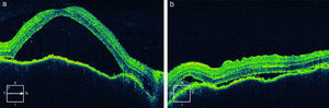 Tomografía de coherencia óptica en paciente con síndrome de Vogt-Koyanagi-Harada precoz (a: ojo derecho, b: ojo izquierdo). Desprendimiento exudativo de retina. Se observa separación entre el epitelio pigmentario de la retina y la retina neurosensorial con fluido subretiniano en su interior.