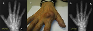 Artritis tuberculosa de la 2.a metacarpofalángica en su presentación (a) y evolución durante su tratamiento (b).