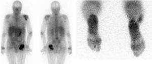 La gamagrafía con Ga67 permite detectar la afectación politópica. Artritis séptica de hombro izquierdo, trapecio, metacarpiana derecha, osteomielitis del 2.° dedo del pie derecho e infección sobre osteosíntesis de cadera izquierda.