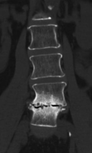 Tomografía computarizada de la columna lumbar. Fenómeno de vacío discal, esclerosis de plataformas vertebrales L4-L5 con erosiones.