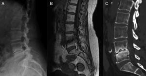 Modic I y III. Importante pinzamiento discal L4-L5 con erosiones en las plataformas vertebrales (A), ausencia de hiperintensidad de la señal en el disco intervertebral en T2 (B). La TC muestra un patrón degenerativo tipo Modic (C) y evita la realización de punción biopsia.