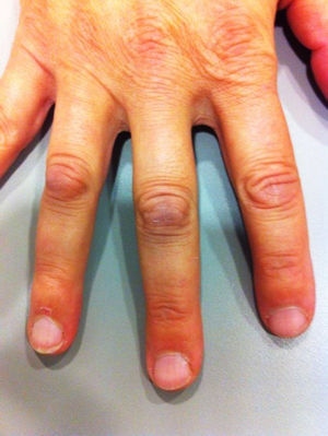 Nódulos de Garrod en el dorso de las articulaciones metacarpofalángicas proximales de la mano.