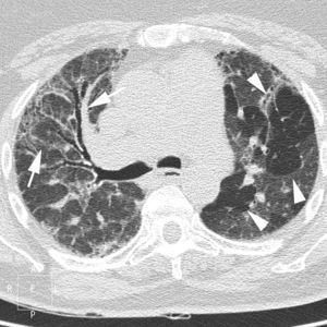 Imagen TCAR centrada en lóbulos superiores en un paciente con alveolitis alérgica extrínseca en fase crónica, que destaca la presencia de opacidades reticulares, bronquiectasias de tracción y «vidrio deslustrado» (flechas), asociado a áreas focales de atrapamiento aéreo en lóbulo superior izquierdo (cabezas de flecha).