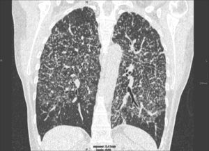Imagen TCMD reconstruida en el plano coronal en una paciente con sarcoidosis, que muestra una afectación micronodular de predominio en campos medios y superiores, asociada a engrosamientos septales.