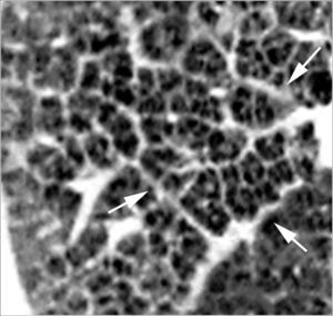 Imagen TCAR localizada en el pulmón derecho que muestra un típico patrón reticular debido al engrosamiento del intersticio intralobular (flechas).