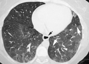 Imagen TCAR localizada en lóbulos inferiores que muestra un tenue aumento de densidad difuso, correspondiente a patrón en «vidrio deslustrado». Nótese que algunos lobulillos pulmonares no están afectados (flechas). Existe engrosamiento de las paredes bronquiales (cabeza de flecha) y una discreta dilatación esofágica (flecha negra).