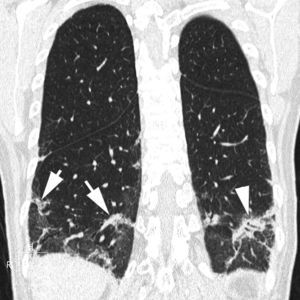 Imagen TCMD reconstruida en el plano coronal y que muestra condensaciones bibasales de morfología arqueada (flecha). En alguna de las condensaciones se observa la presencia de broncograma aéreo (cabeza de flecha).