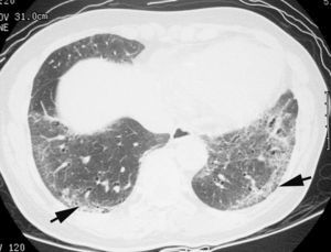 Imagen TCAR localizada en lóbulos inferiores en paciente con patrón de neumonía intersticial no específica. Se observa la presencia de áreas periféricas de densidad en «vidrio deslustrado» y opacidades reticulares (flechas).