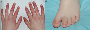 Artritis psoriásica juvenil (APso-J). A)Lesiones cutáneas y oligoartritis asimétrica en las manos de una adolescente con APso-J de inicio tardío. B)Dactilitis en el segundo dedo de pie izquierdo en un niño con APso-J de inicio precoz.