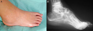 a)Fase aguda de la tarsitis en un paciente con artritis relacionada con entesitis. B)Tarsitis anquilosante.