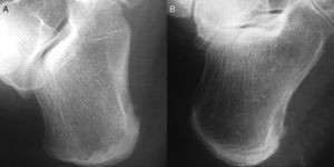 Evolución de los cambios radiológicos a nivel de entesis calcánea plantar en espondiloartritis juvenil, con presencia inicial de erosión (A) y posterior desarrollo de entesofito (B).