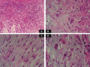A, Foci of dense polymorphic inflammatory infiltrate. Lymphocytes, plasma cells, neutrophils, and numerous eosinophils are present within the myxoid matrix, forming part of the tumor (Hematoxylin-eosin, original magnification x200). B, Population of tumor cells formed of multinucleated Reed-Sternberg-like cells and epithelioid cells (Hematoxylin-eosin, original magnification x400). C, Spindle-shaped tumor cells (Hematoxylin-eosin, original magnification x400). D, Multivacuolated lipoblast-like cells (Hematoxylin-eosin, original magnification x400).