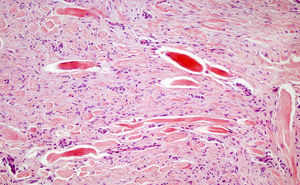 Proliferation of spindle cells between keloid-like collagen fascicles (hematoxylin-eosin, original magnification x150).