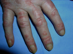Gottron papules on the interphalangeal joints in a patient with dermatomyositis.